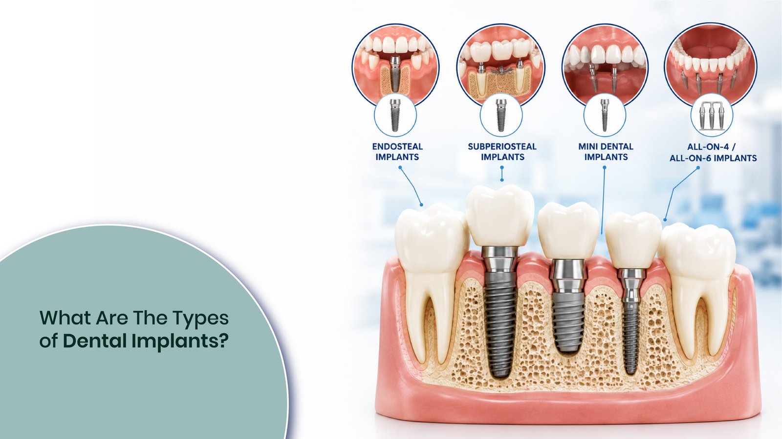 Types of Dental Implants