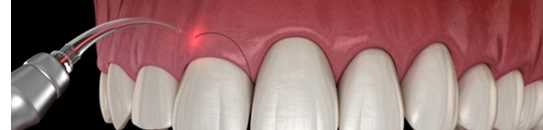 Cosmetic Gum Surgery in Ahmedabad