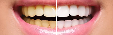 Teeth Whitening