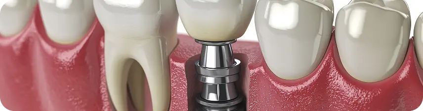 Dental Implants in Ahmedabad