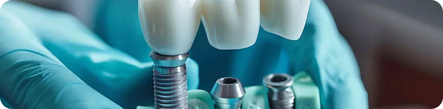 permanent tooth replacement in Ahmedabad
