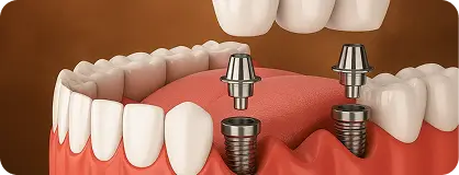 Teeth Implants in ahmedabad