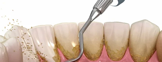 teeth cleaning treatments in Ahmedabad