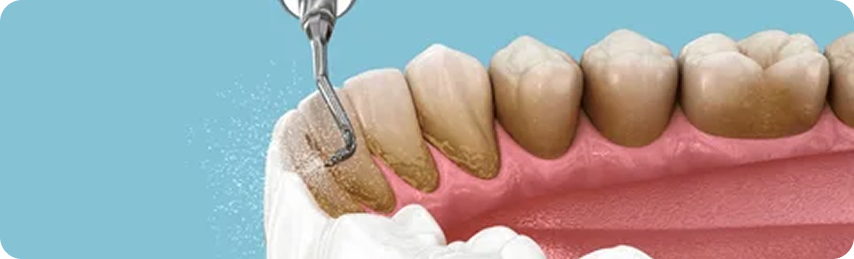 Dental Cleaning Procedure