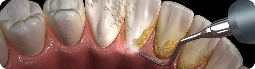 Teeth Scaling and Polishing