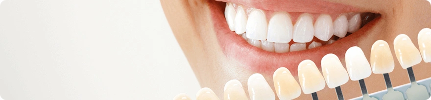  porcelain veneers treatment in Ahmedabad