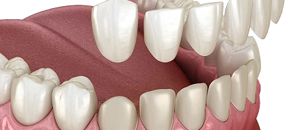 Veneer Treatment in Ahmedabad